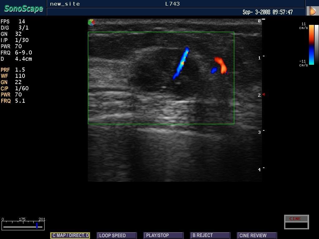 4D Cardiac Stress Color Doppler Ultrasound SonoScape S8