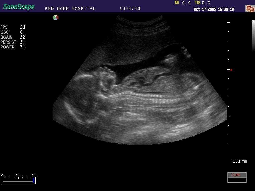 4D Cardiac Stress Color Doppler Ultrasound SonoScape S8