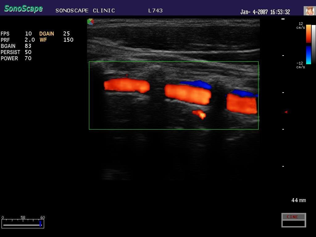 4D Cardiac Stress Color Doppler Ultrasound SonoScape S8