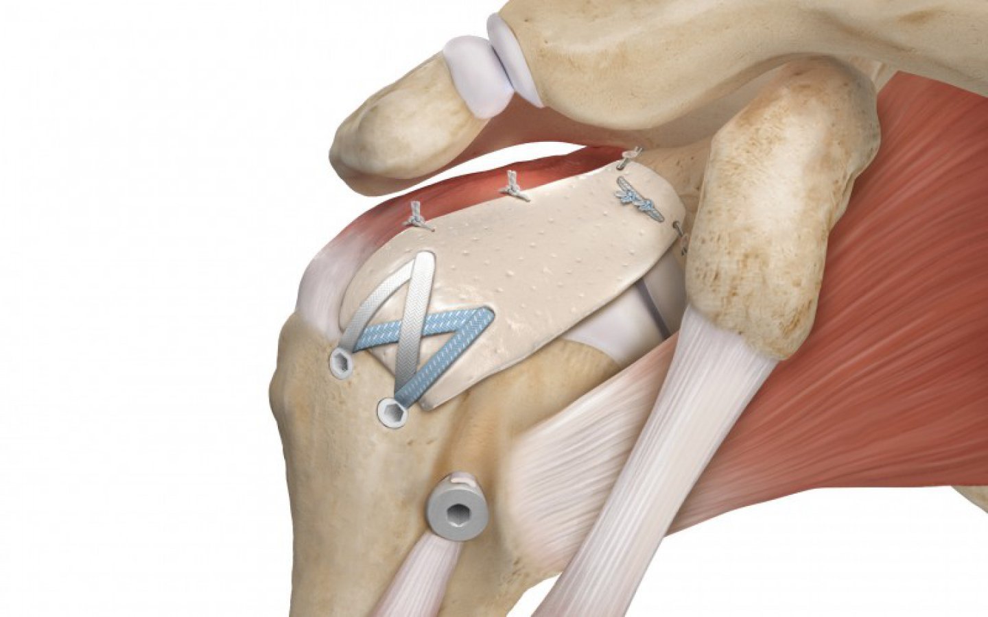 ORTHOPROMED FIBER TAPE SUTURE