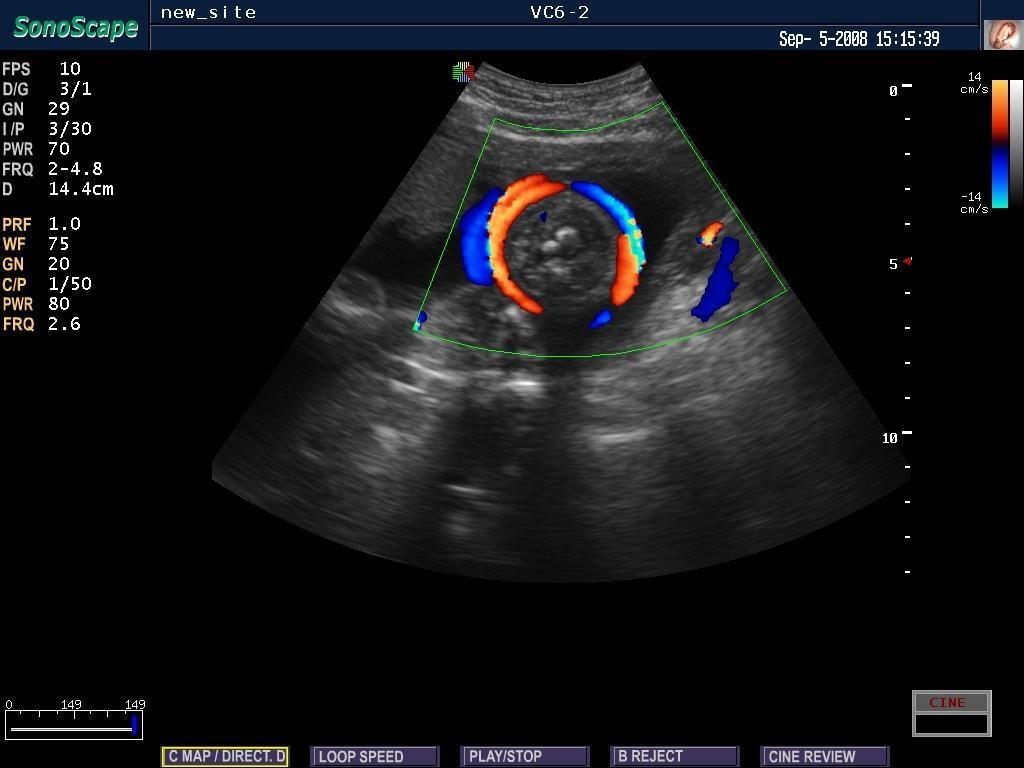 4D Cardiac Stress Color Doppler Ultrasound SonoScape S8