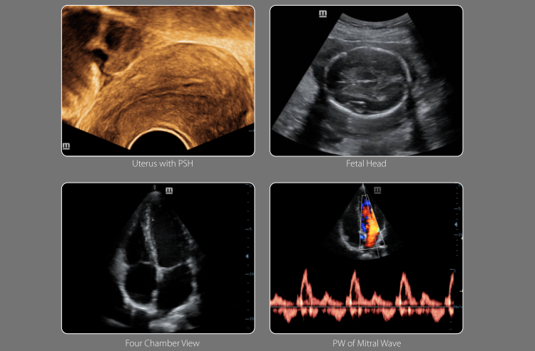 Cardiac 4D Color Doppler Ultrasound Mindray DC-30