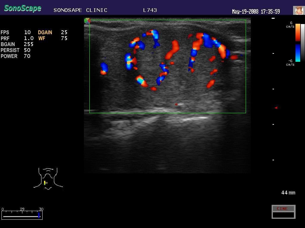 4D Cardiac Stress Color Doppler Ultrasound SonoScape S8